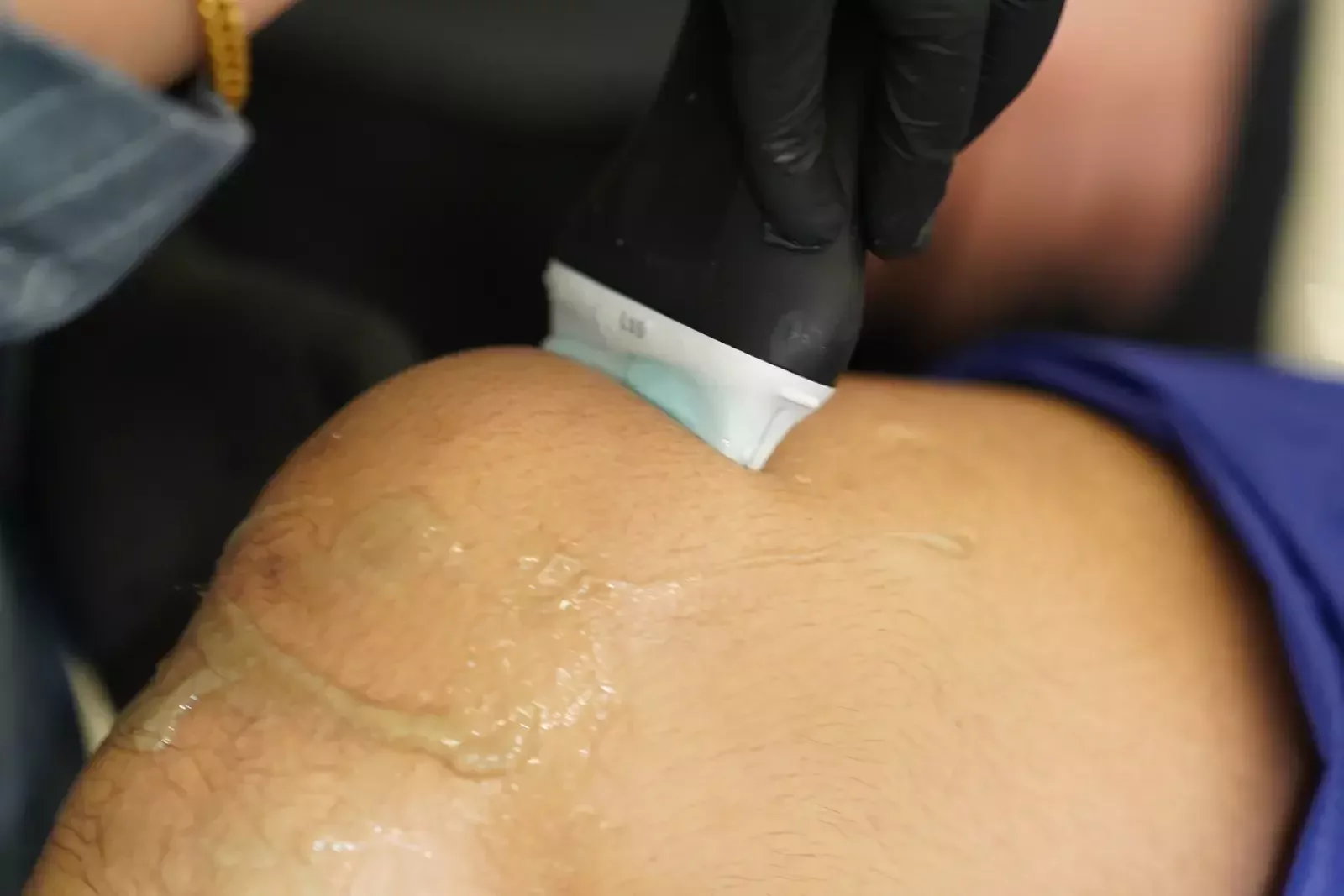 مسبار محمول على الركبة مع جل الفحص / Handheld probe on a knee with scanning gel